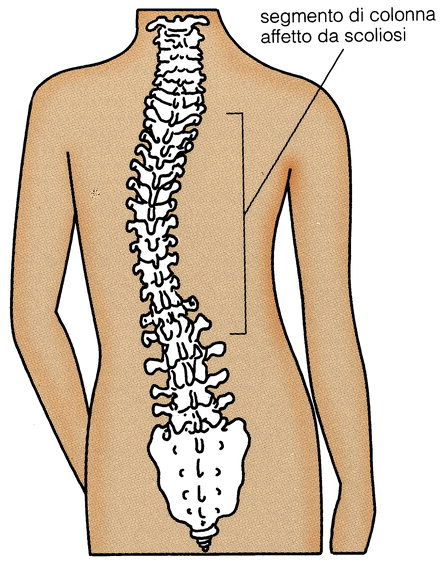 come curare la scoliosi 2